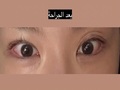 إعادة جراحة الجفن المزدوج، وإعادة تصحيح شكل العين مع المدير الطبي دو أون روك