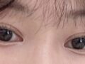 تجربة المريض مع الالتصاق الطبيعي للمدير الطبي كيم هونغ جين!!
