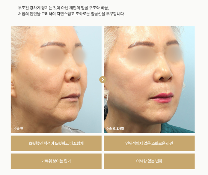 1mm جراحة التجميل Facefit شد الوجه المصغر صورة 5