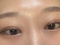 นี่คือรีวิวเกี่ยวกับการผ่าตัดทำตาสองชั้นและการผ่าตัดแก้ไขหนังตาตก!