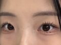 非切開二重まぶた+ウィット