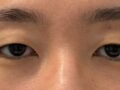 埋线双眼皮 一个月 术后