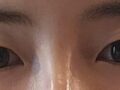 ยกกระชับเปลือกตาบนแบบไม่ผ่าตัด +