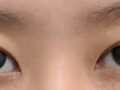 นี่คือบทวิจารณ์เกี่ยวกับการยกกระชับเปลือกตาบนโดยไม่ต้องผ่าตัด