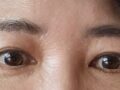 切眉提升+下眼睑