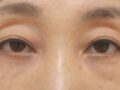 桃園長/切開、目の矯正、目の上の脂肪移植