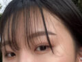 都彦禄院长  双眼皮修复 术后反馈!!!