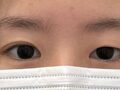 金洪振院长  双眼皮修复 术后反馈