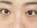 自然癒着ペアカップル手術後期です！