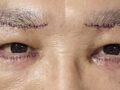 50代の男は言葉帳院長の手術後期です