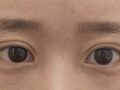 都彦禄院长   双眼皮修复  术后