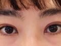 一毫米 都彦禄院长  双眼皮修复  反馈