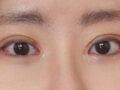 都彦禄院长  双眼皮修复 术后反馈