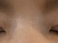 全切双眼皮+上眼角