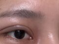 双眼皮修复  术后反馈