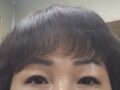 全切双眼皮 术后反馈
