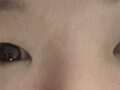 การผ่าตัด + ศัลยกรรมตกแต่งหัวตา