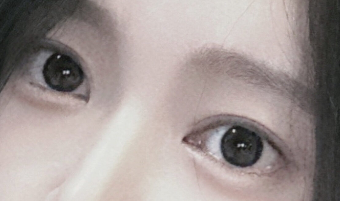 รีวิวการยกกระชับเปลือกตาบนด้วยวิธี Natural Adhesion หลังใช้ 2 เดือน