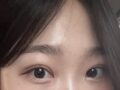 都彦禄院长   双眼皮修复
