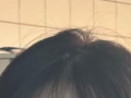 自然粘连  都彦禄院长  术后反馈