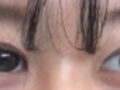 都彦禄院长   自然粘连一个月术后复查