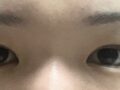 自然粘连+上眼角   术后一个月