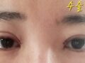 埋线双眼皮+上眼角