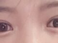 การยกเปลือกตาบน การผ่าตัดแก้ไขสายตา