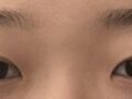 埋线双眼皮 修复