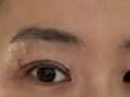 都彦禄院长   双眼皮修复 术后反馈