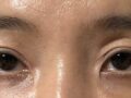 ผู้กำกับ โด วอน-รก การปลูกถ่ายไขมันแบบธรรมชาติ + การจัดตำแหน่งไขมันใต้ตาใหม่ + การปลูกถ่ายไขมันเปลือกตาบน + การปลูกถ่ายไขมันแก้ม