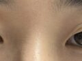 都彦禄院长   双眼皮修复