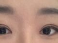 ผู้กำกับ โด ออน-ร็อก - รีวิวการผ่าตัดทำตาสองชั้น Incision