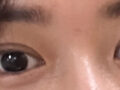 双眼皮修复  第5周 术后反馈
