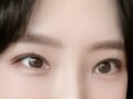 一毫米 都彦禄院长 双眼皮术后反馈