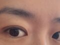 双眼皮修复  都彦禄院长  术后两个月