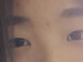 自然粘连  术后反馈