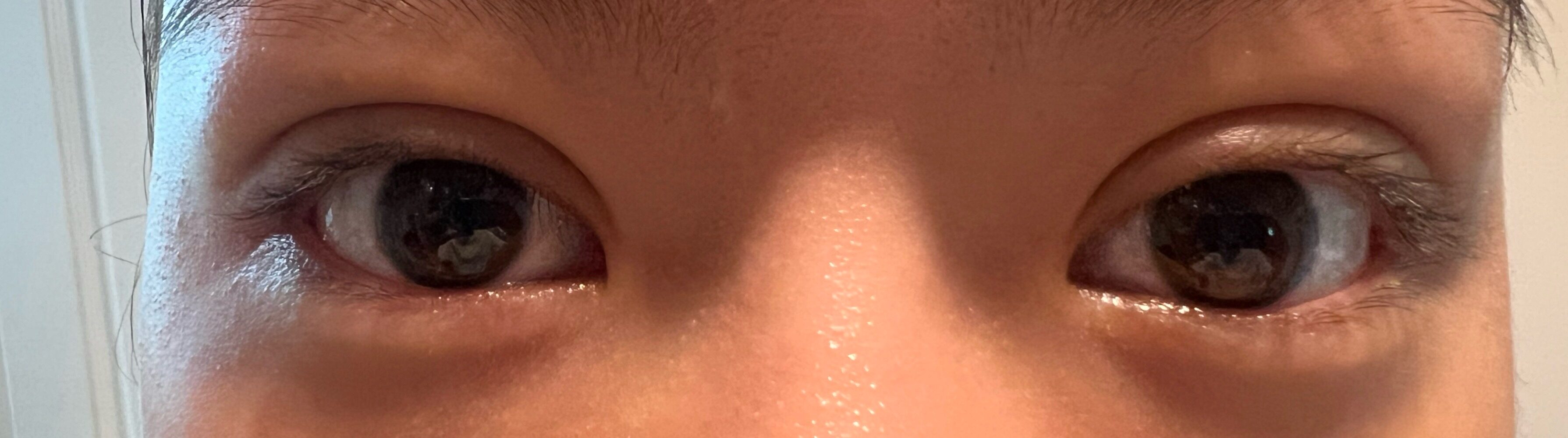 都彦禄院长  埋线双眼皮