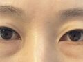 都彦禄院长  双眼皮手术后反馈