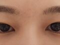 都彦禄院长  全切双眼皮+提肌 术后反馈