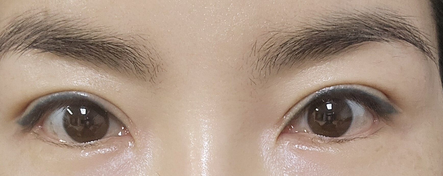 术后一个月