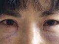 都彦禄院长做的 眼底脂肪重排