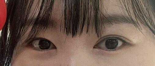 眼科修复手术前！