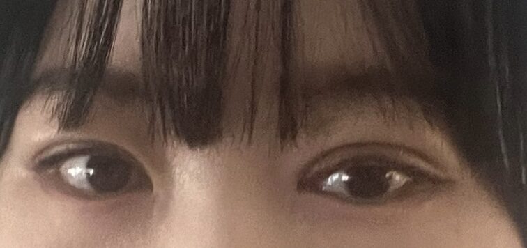 拆线一周后！
