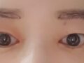 切眉提升 术后反馈