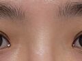 รีวิวการผ่าตัดทำตาสองชั้นของ ดร.คิม ฮงจิน
