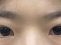 ศัลยกรรมแก้ไขเปลือกตาสองชั้น (ผู้กำกับ โด ออน-รก)