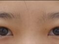 ศัลยกรรมทำตาสองชั้น (แบบธรรมชาติ) ,, ศัลยกรรมตกแต่งหัวตา ,, การกำจัดไขมันรอบดวงตา