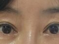 双眼皮修复  