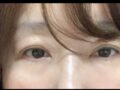 都彦禄院长 上眼角术后两个月反馈